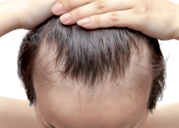 Causas da Alopecia