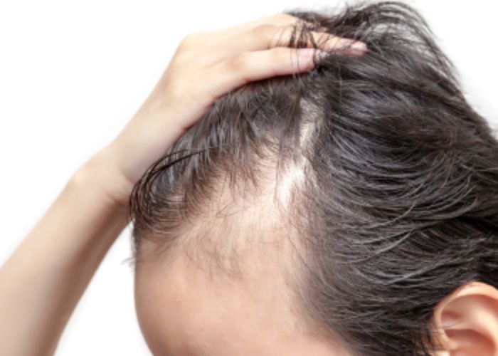 Alopecia No Instituto Shalon oferecemos soluções eficazes para alopecia, causada por fatores genéticos, desequilÃbrios hormonais, inflamações e estresse crônico.