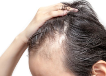 Alopecia