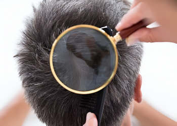 Alopecia - Tratamentos
