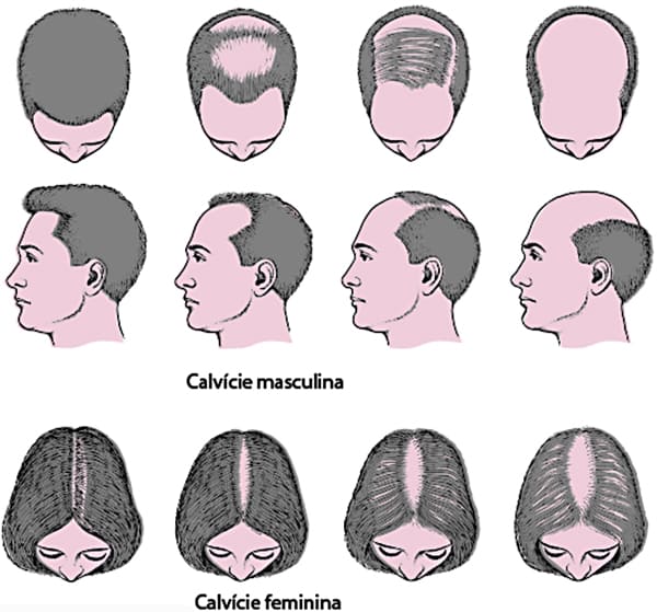 a-calvicie